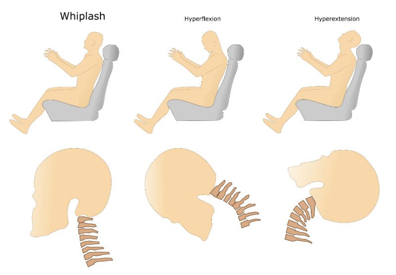 Car accidents and whiplash