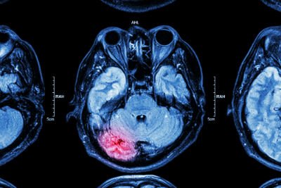 Our brain injury lawyers report on the impact of undetected traumatic brain injuries.