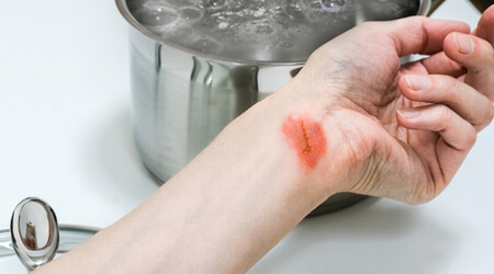 burn injury