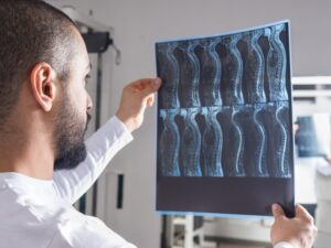 doctor looking at an xray film of a spinal-cord with injury