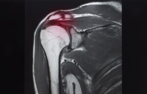 MRI scan of a shoulder showing a torn rotator cuff injury