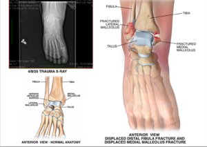 Imaging for an ankle injury for a $1.59 million settlement
