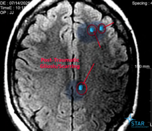 Imaging for a brain injury for a $1.59 million settlement