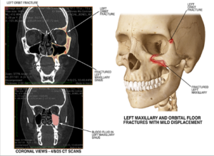 Imaging for a facial fracture injury for a $1.59 million settlement