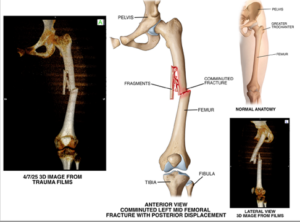 Imaging for a leg injury for a $1.59 million settlement